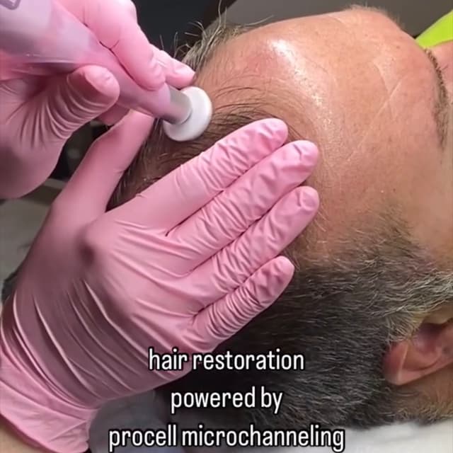 Scalp Microchanelling at Glow Aesthetics in Temecula, CA